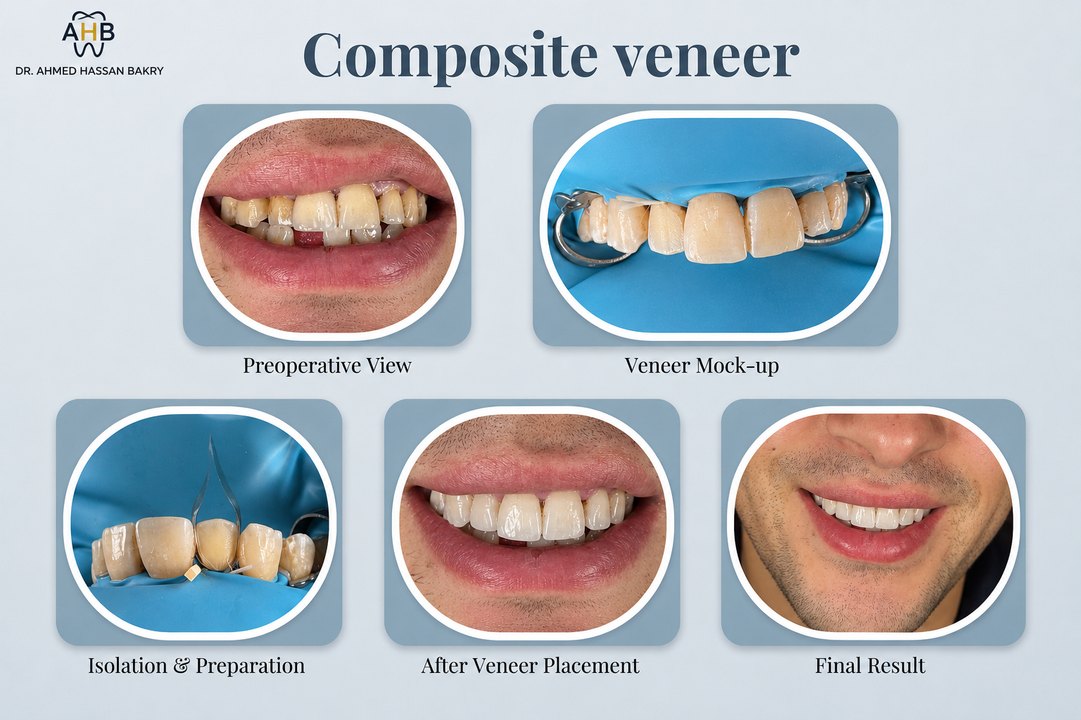 Composite Veneer